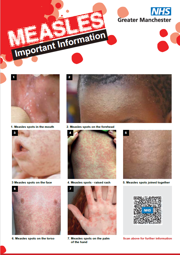 Measles